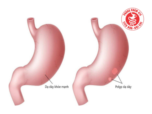 polyp dạ dày là gì