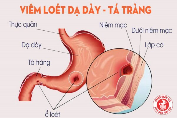 DẤU HIỆU CẢNH BÁO BỆNH VIÊM LOÉT DẠ DÀY TÁ TRÀNG